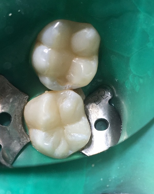 Лечение зубов у детей вероника