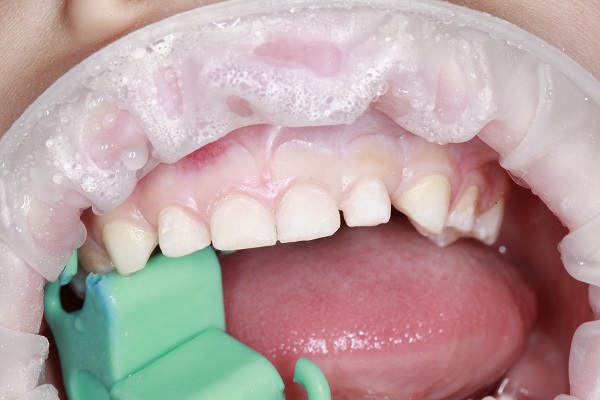 Лечение зубов у детей вероника