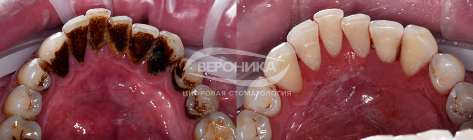 Результаты профессиональной гигиены полости рта и удаления зубного камня