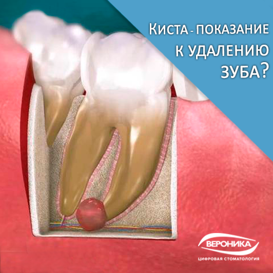 Киста зуба - показание к удалению?